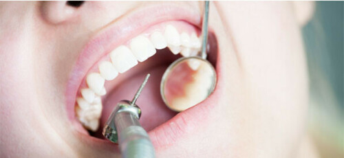 Your dentist has recommended that you see a periodontist, a dental specialist who treats periodontal disease. Periodontal disease is a bacterial infection..

Read More: https://mittaldentalclinic.com/gum-surgery/